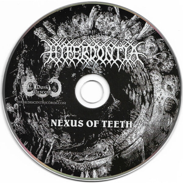  Hyperdontia (2)  -  nexus of teeth 